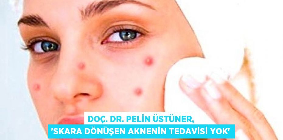 DOÇ. DR. PELİN ÜSTÜNER, 'SKARA DÖNÜŞEN AKNENİN TEDAVİSİ YOK'