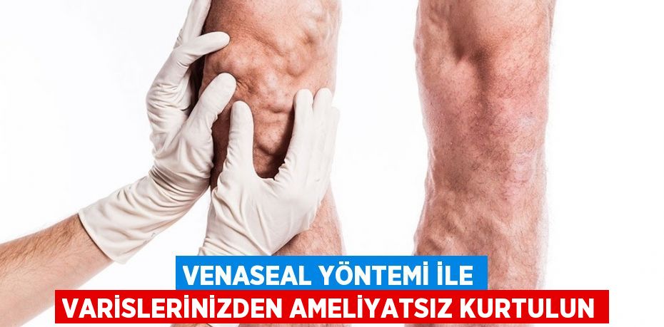 VENASEAL YÖNTEMİ İLE VARİSLERİNİZDEN AMELİYATSIZ KURTULUN