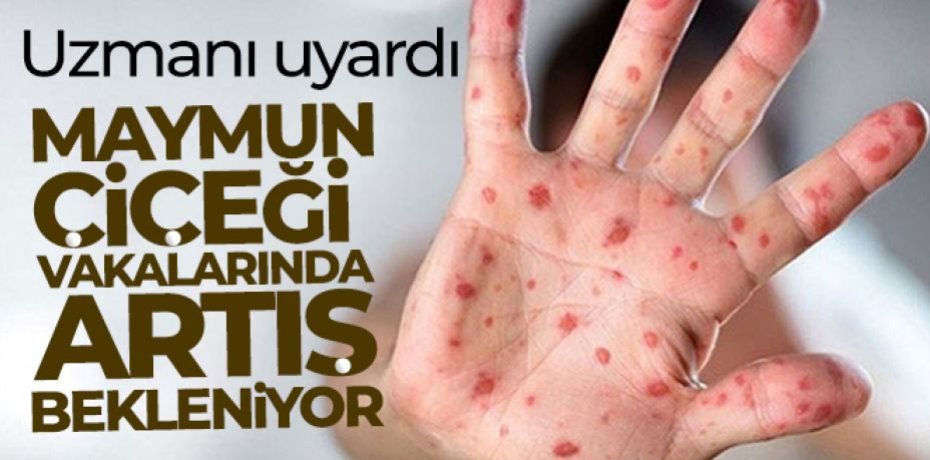 Uzmanı uyardı: Maymun çiçeği vakalarında artış bekleniyor